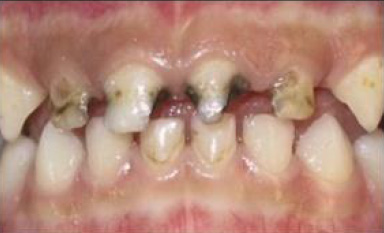 Face N Dental International Clinic in Nigdi Pimpri Chinchwad Pediatric Dentistry3