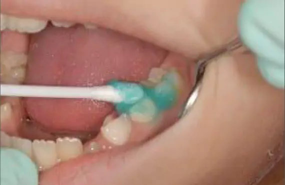 Face N Dental International Clinic in Nigdi Pimpri Chinchwad Fluoride Therapy2