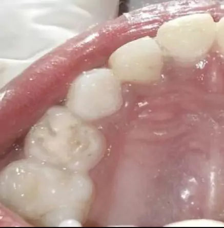 Face N Dental International Clinic in Nigdi Pimpri Chinchwad Filling Procedures After