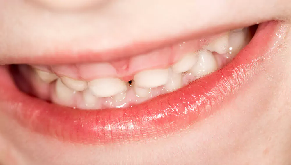 Face N Dental International Clinic in Nigdi Pimpri Chinchwad Pediatric Dentistry