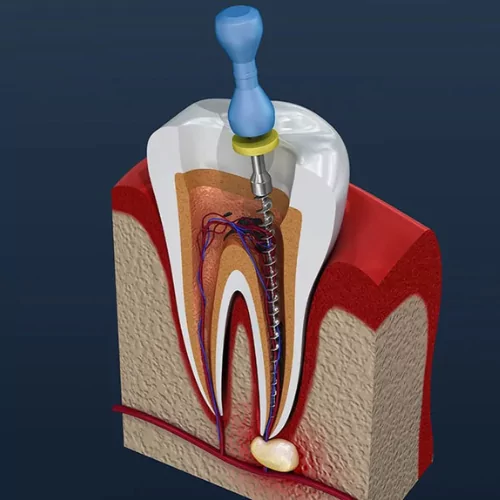 Face N Dental International Clinic in Nigdi Pimpri Chinchwad Advance Root Canal Treatment