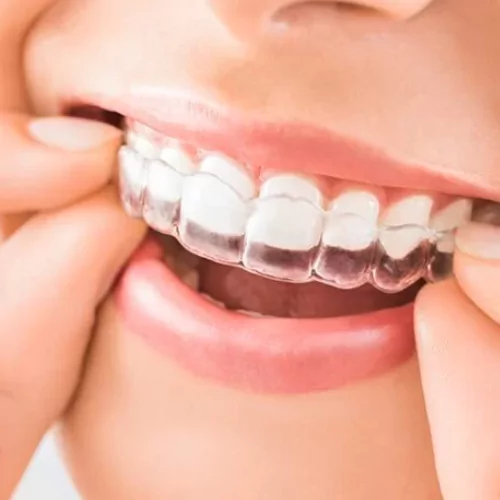 Face N Dental International Clinic in Nigdi Pimpri Chinchwad Aligners and Ortho