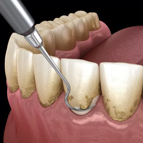 Face N Dental International Clinic in Nigdi Pimpri Chinchwad Teeth Cleaning & Gum Diseases Treatment