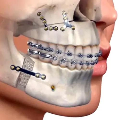 Face N Dental International Clinic in Nigdi Pimpri Chinchwad Face Trauma and Jaw Surgery
