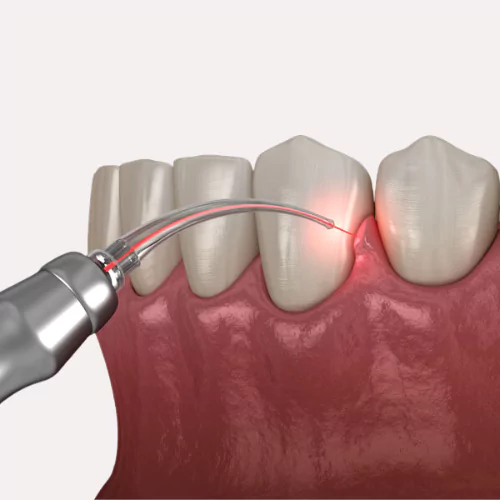 Face N Dental International Clinic in Nigdi Pimpri Chinchwad The Laser Gum Treatment & Surgery