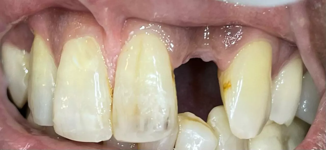 Replacement of Missing Teeth in Nigdi Pimpri Chinchwad Pune