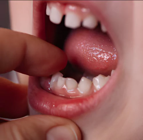 Face N Dental International Clinic in Nigdi Pimpri Chinchwad Pediatric Dentistry