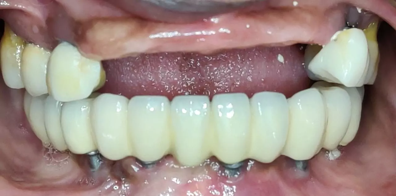 Face N Dental International Clinic Dental Implant before image In Nigdi Pune