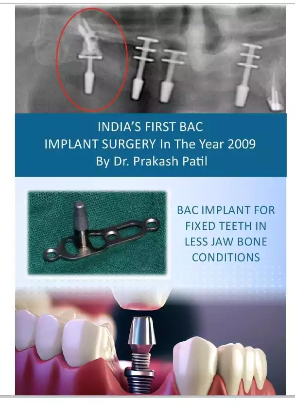 Face N Dental International Clinic in Nigdi Pimpri Chinchwad BAC Implant Surgically