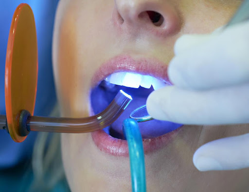 Laser Gum Treatment in Nigdi face n dental international clinic