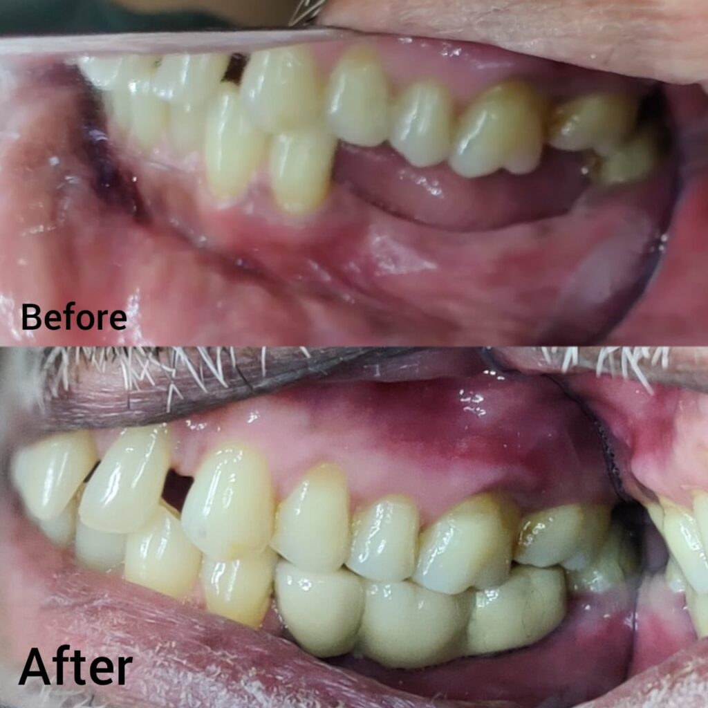 Replacement of Missing Teeth in nigdi