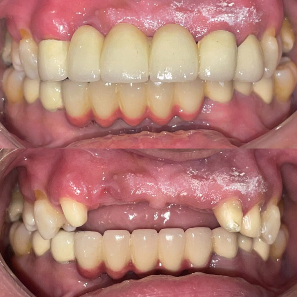 Replacement of Missing Teeth in nigdi