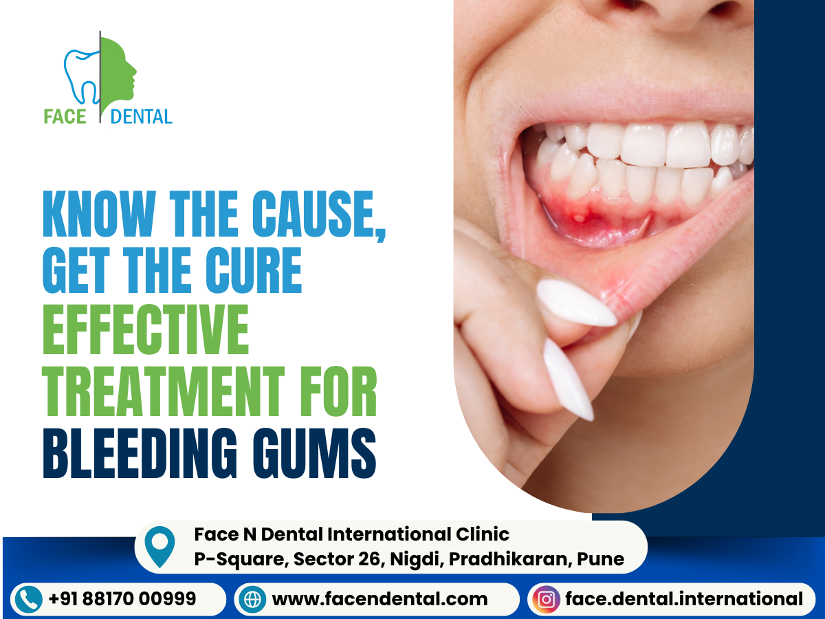 Face N Dental International Clinic Bleeding Gums Treatment in Pimpri Chinchwad