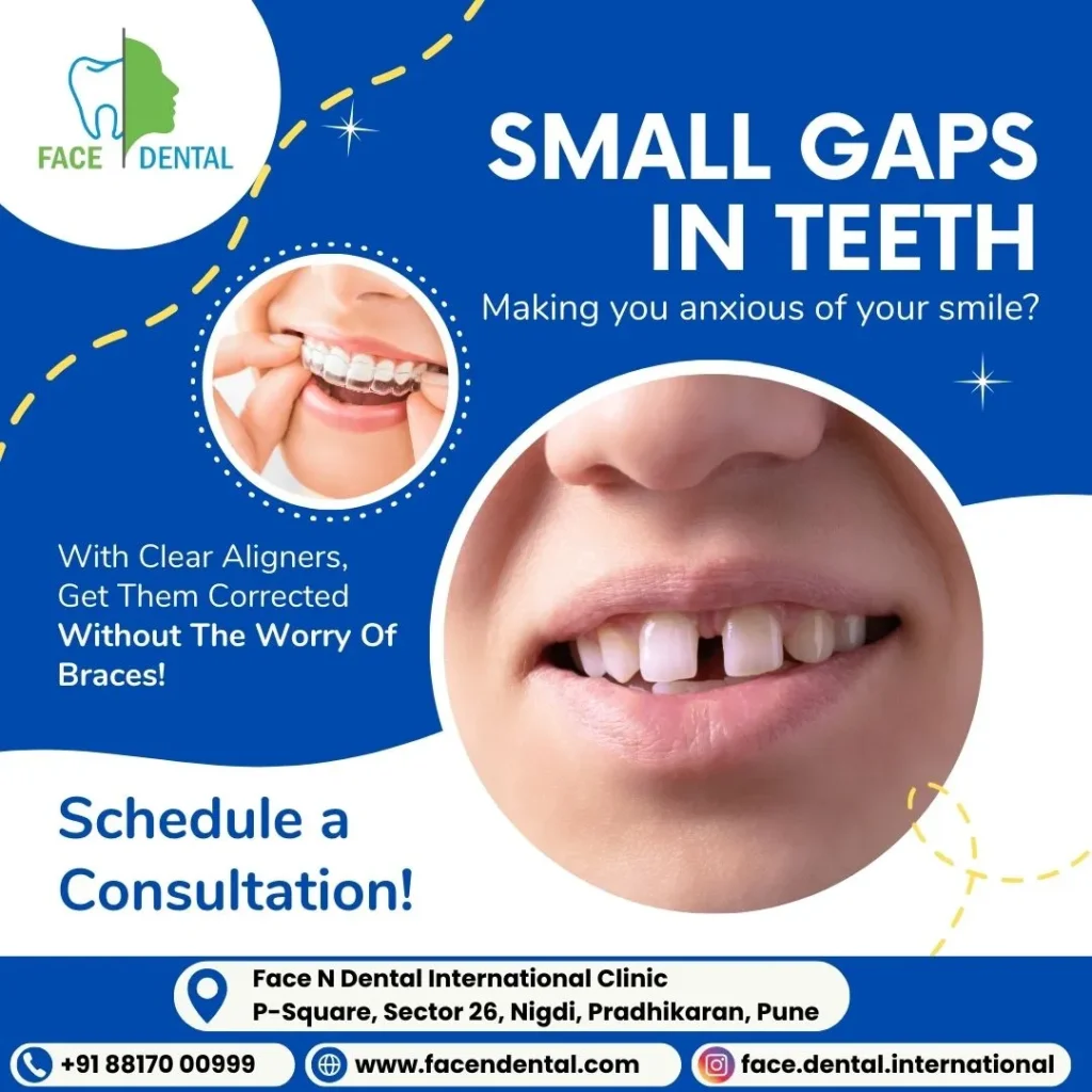 Close the Gap: Effective Teeth Spacing Treatments in Pimpri Chinchwad